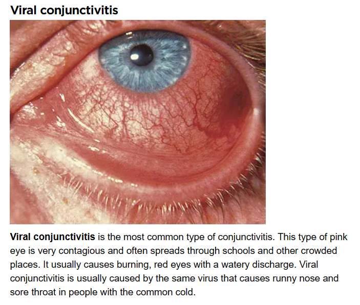 डोळे आलेत? सेल्फ मेडिकेशन नको, ही घ्या काळजी