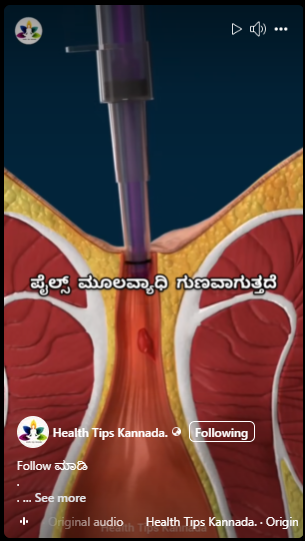 ತುಪ್ಪ ಮತ್ತು ಕರಿಮೆಣಸು 10 ದಿನಗಳಲ್ಲಿ ಪೈಲ್ಸ್ ಅನ್ನು ಗುಣಪಡಿಸಬಹುದೇ?